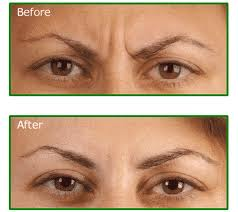 shumailas.com Botox