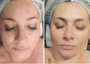 Another CACI (Non-Surgical Face Lifts) customer, before and after Image of CACI (Non-Surgical Face Lifts) customer, before and after