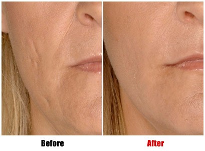 See how Dermal Fillers can plump nose to mouth lines Dermal Fillers Before-After: Nose to Mouth Lines