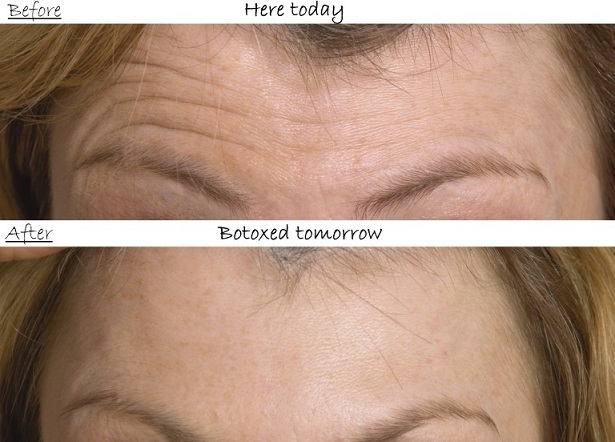 Before-After of Botox Treatment for Worry Lines on the Forehead Botox Before-After: Forehead Worry Lines