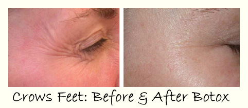 Botox Wrinkle Treatment erases crows feet Botox Before-After: Crows Feet