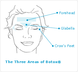 Botox to fill worry lines, frown lines and crows feet Botox Main Facial Areas: Forehead & Eyes