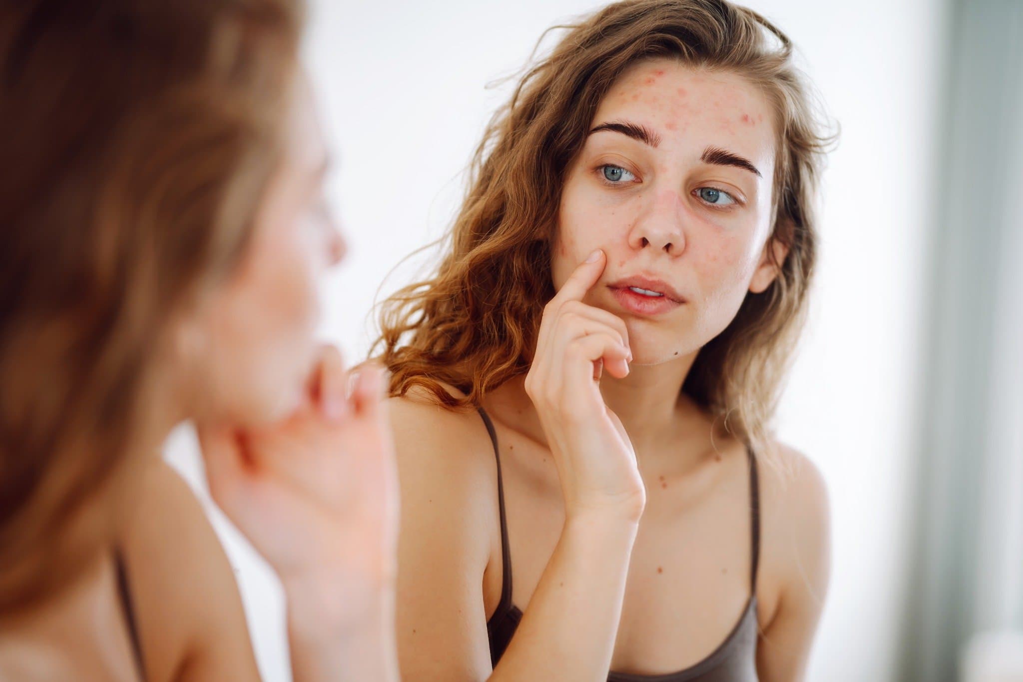 “Acne Laser Treatment: The Skin-Clearing Breakthrough Changing Lives”
