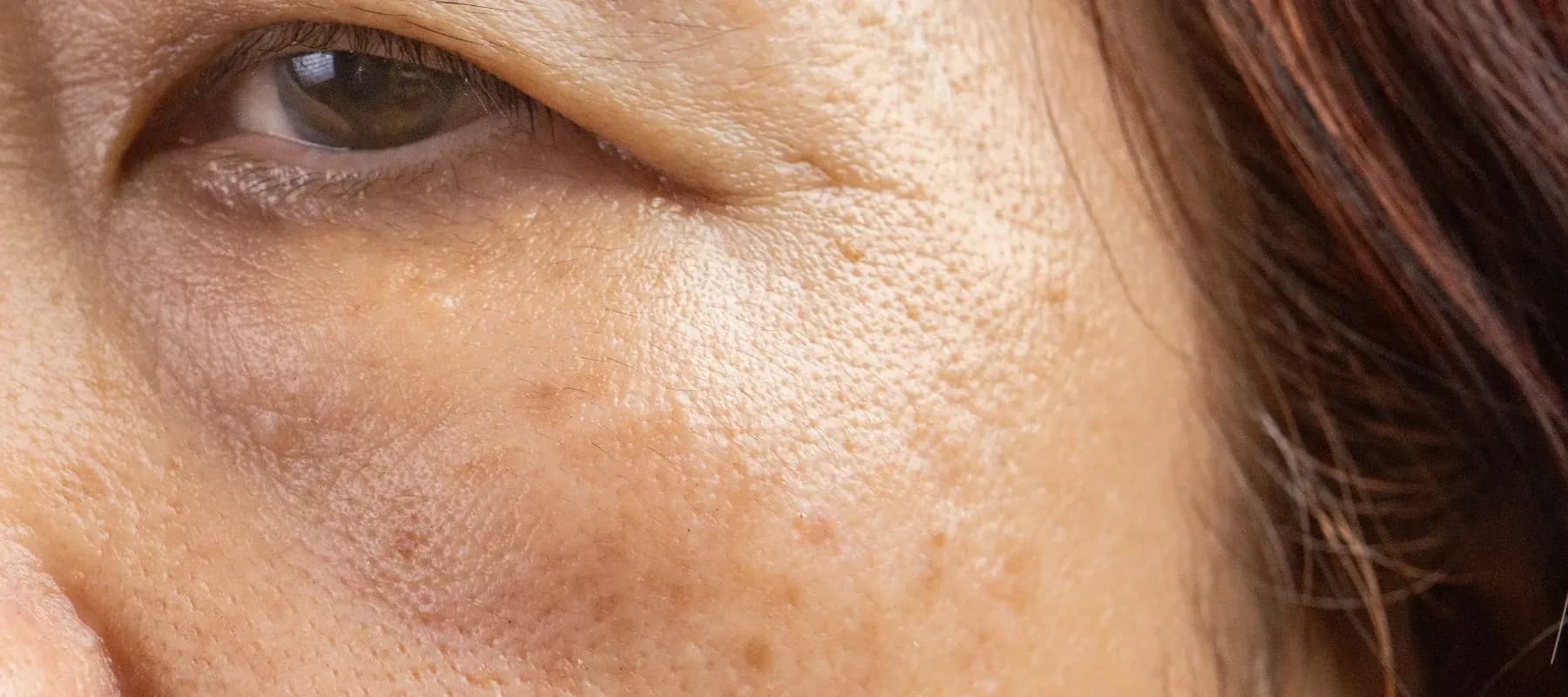Age Spots: What They Are, How to Treat Them and Best Results