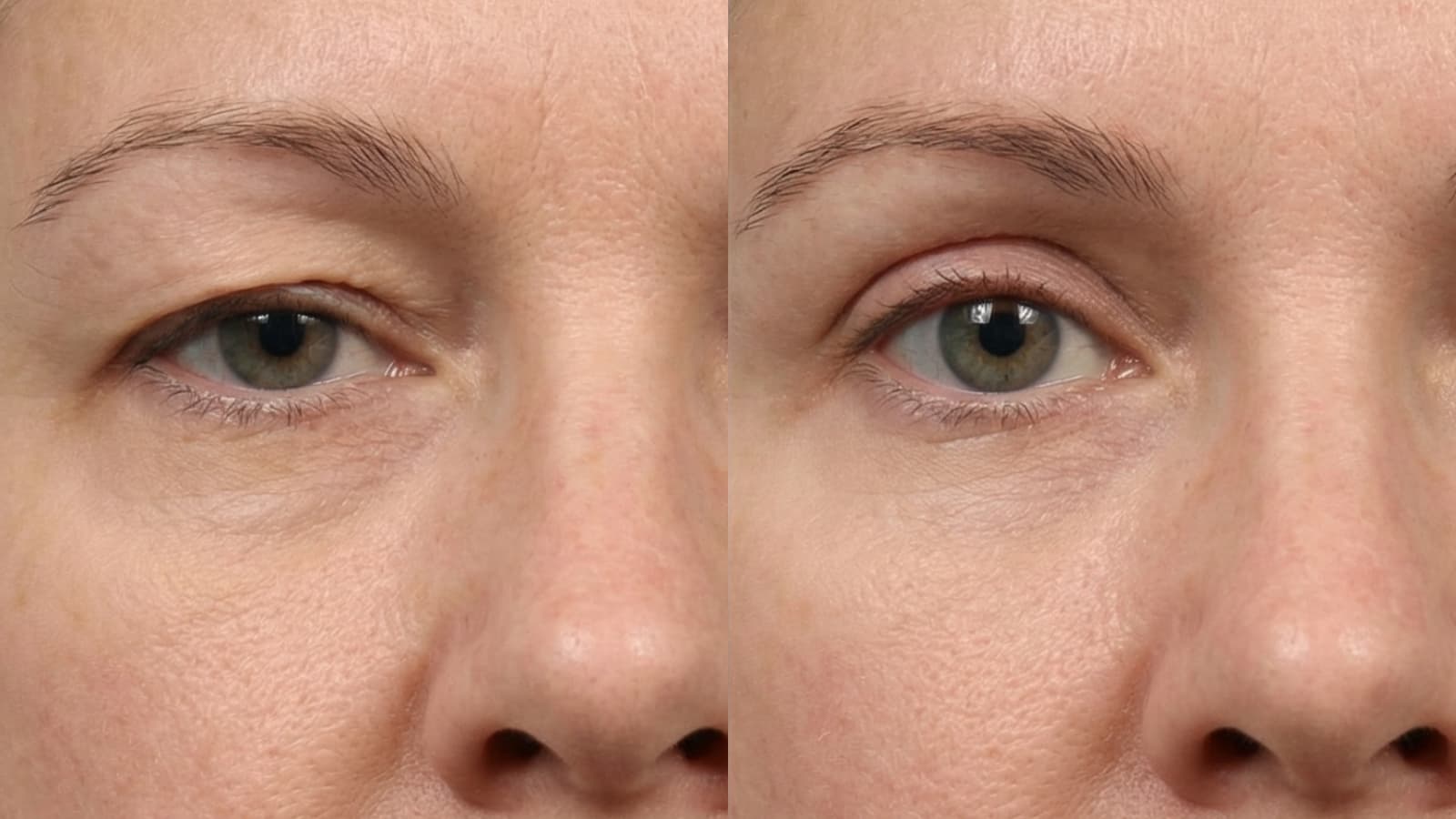 What We Actually Know About Eyelid Lift Surgery in 2025