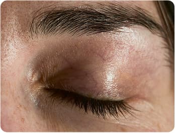 Eyelid Lift