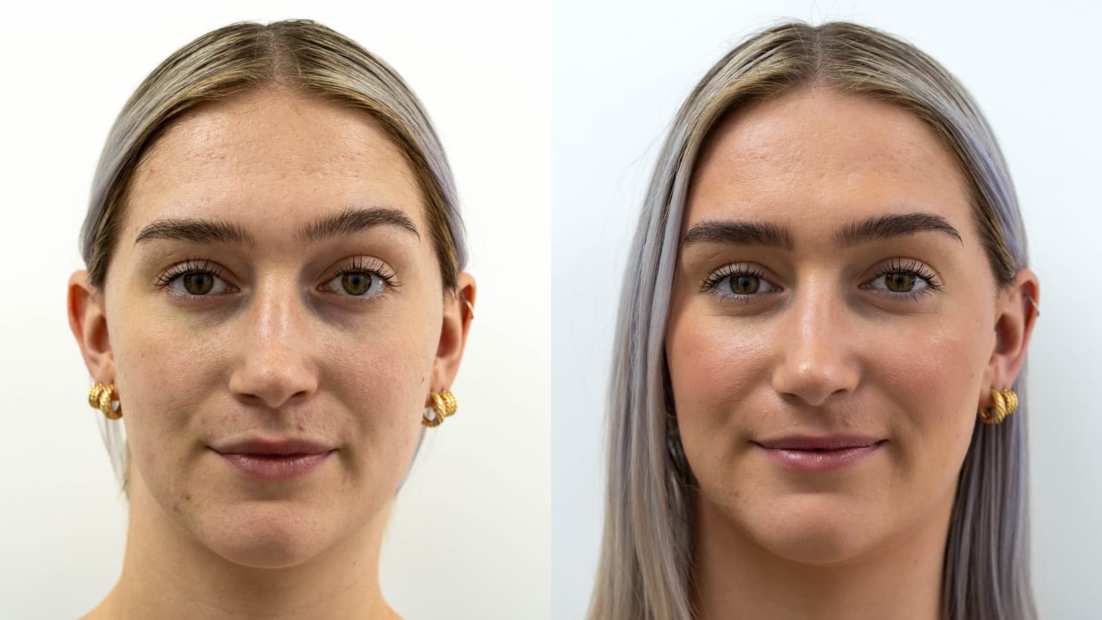 What We’re Learning About Face and Neck Lifts in 2024: The Data Behind the Surge