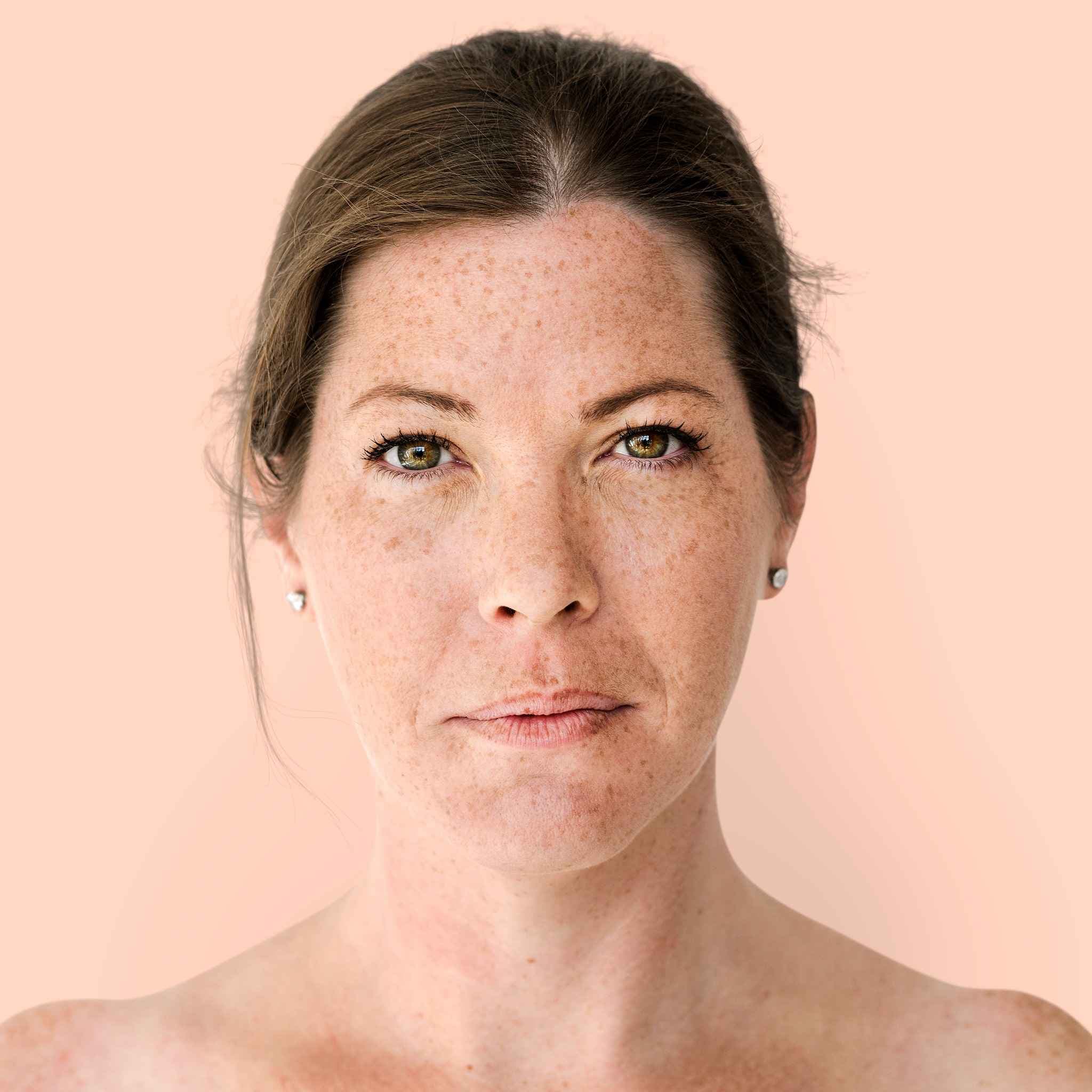 Middle-aged woman with freckles looking at the camera before freckle removal treatment