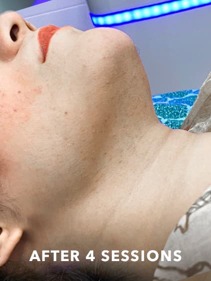 best laser hair removal london chin after 4 sessions