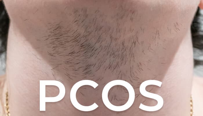 pcos laser hair removal