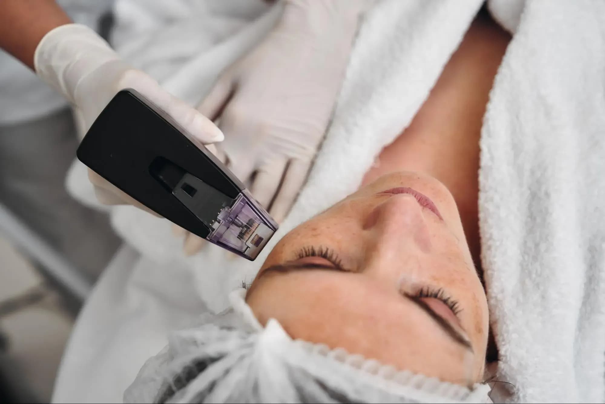 Rf Microneedling treatment being performed on a female client’s face at a professional skincare clinic
