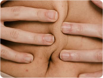 Tummy Tuck