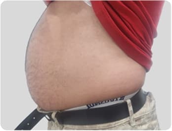 Weight Loss Injection