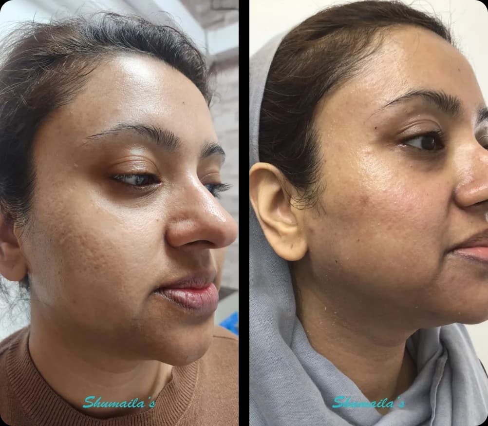 Acne Laser Treatment
