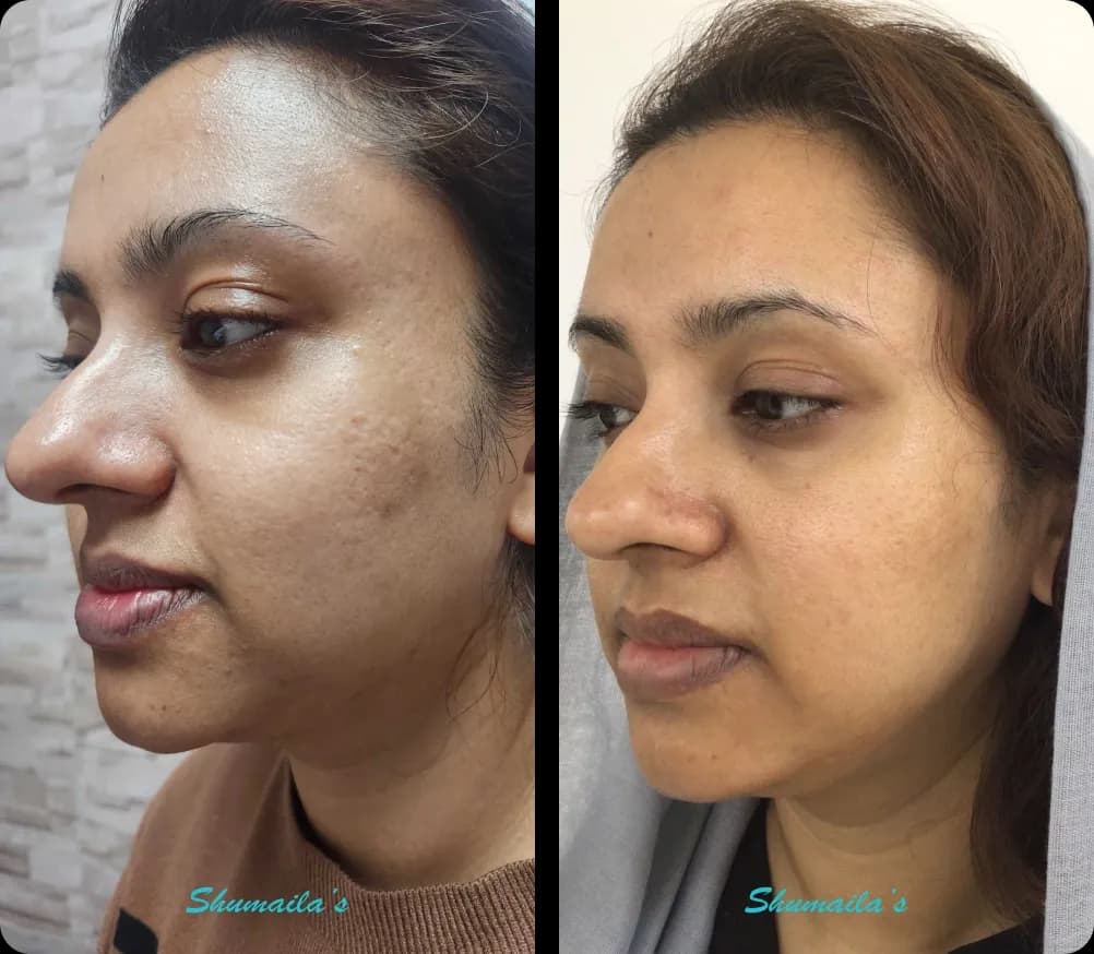 Acne Laser Treatment