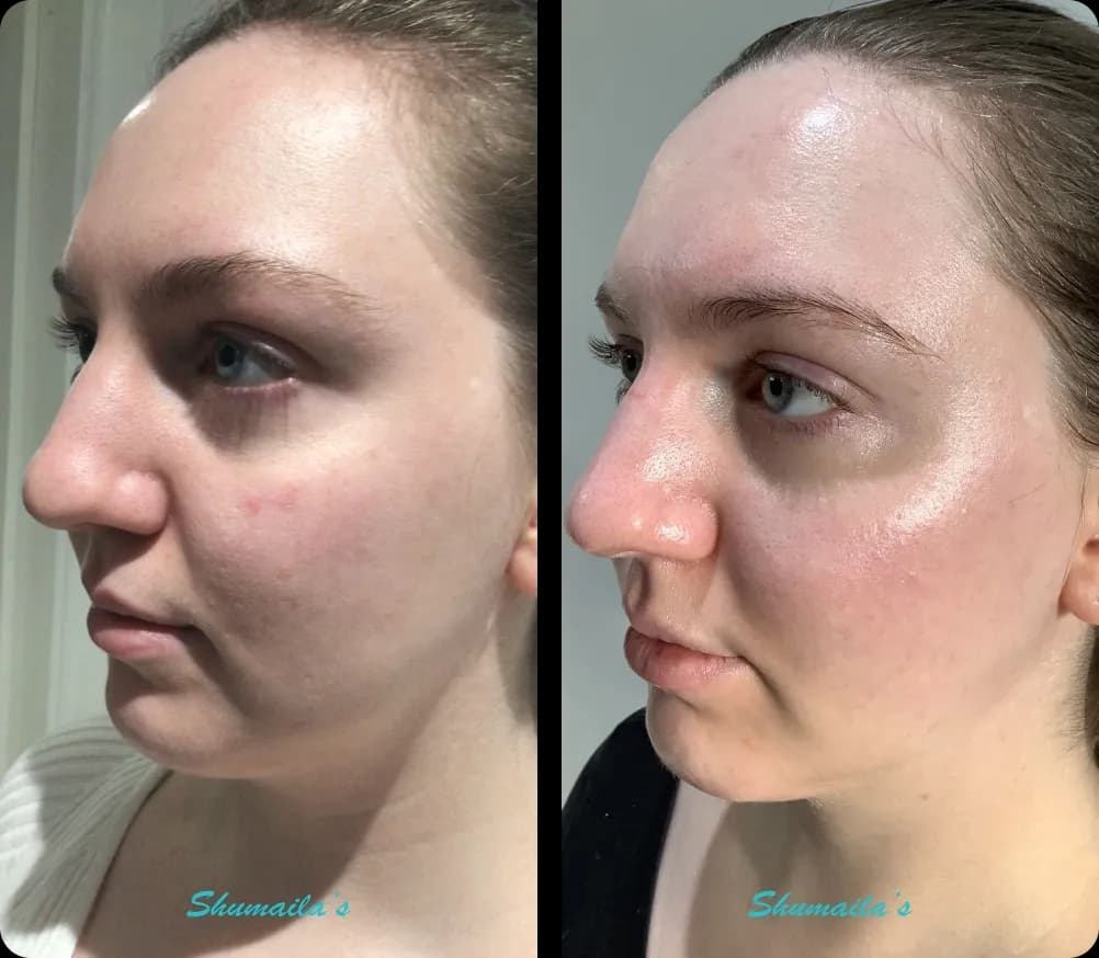 Acne Laser Treatment