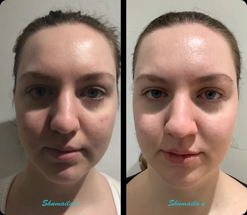 Acne Laser Treatment