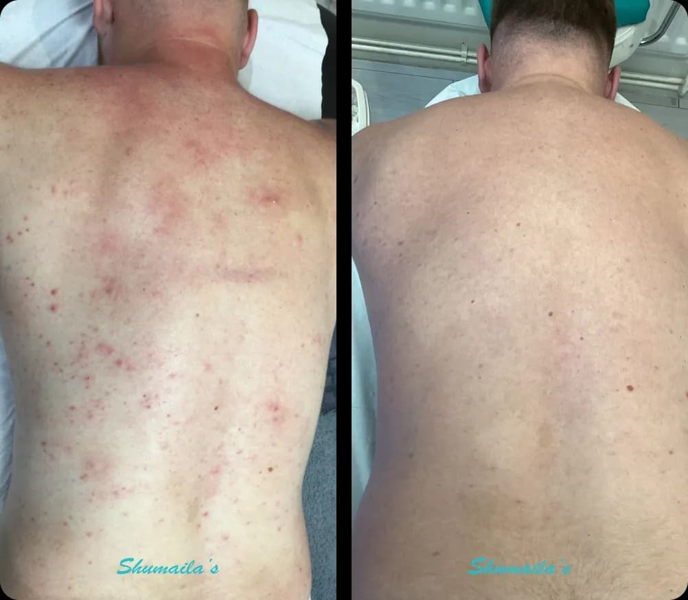 Acne Laser Treatment
