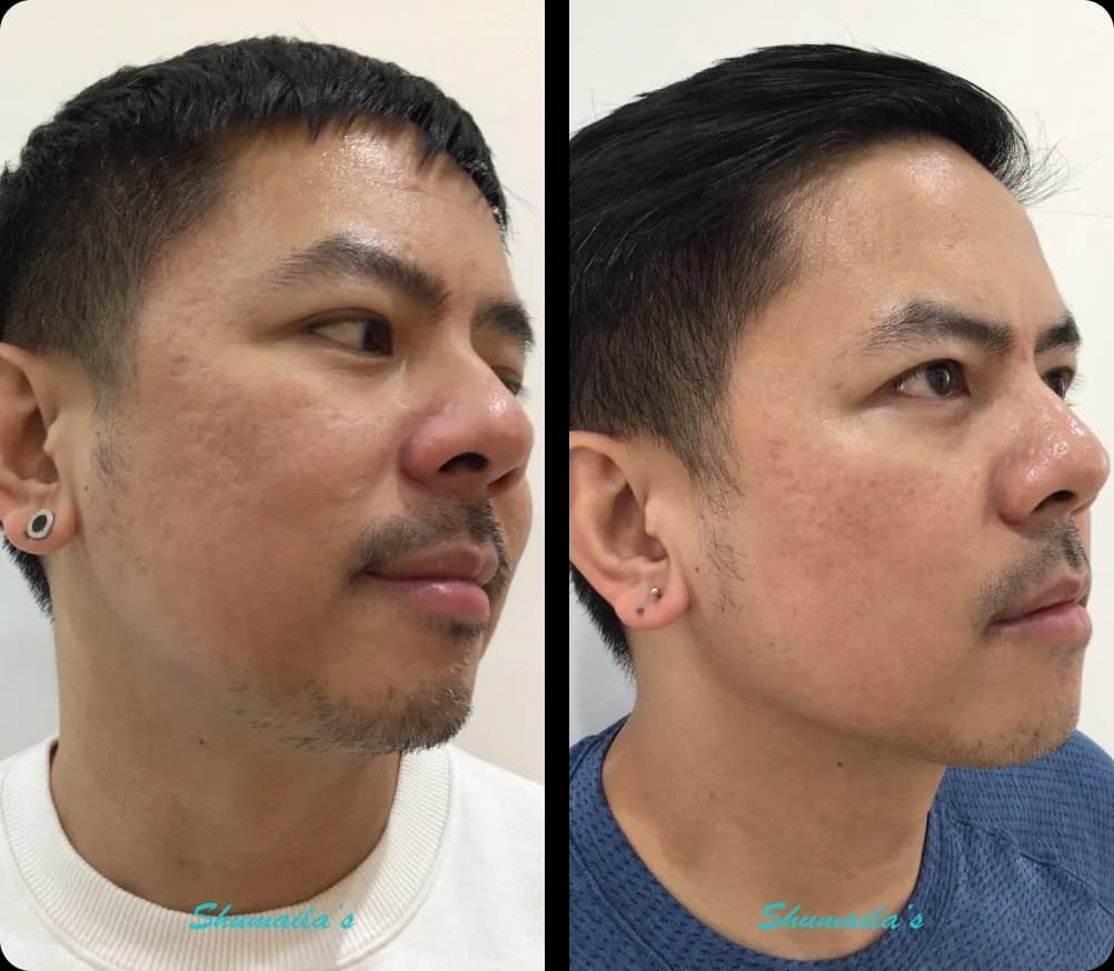 Acne Laser Treatment