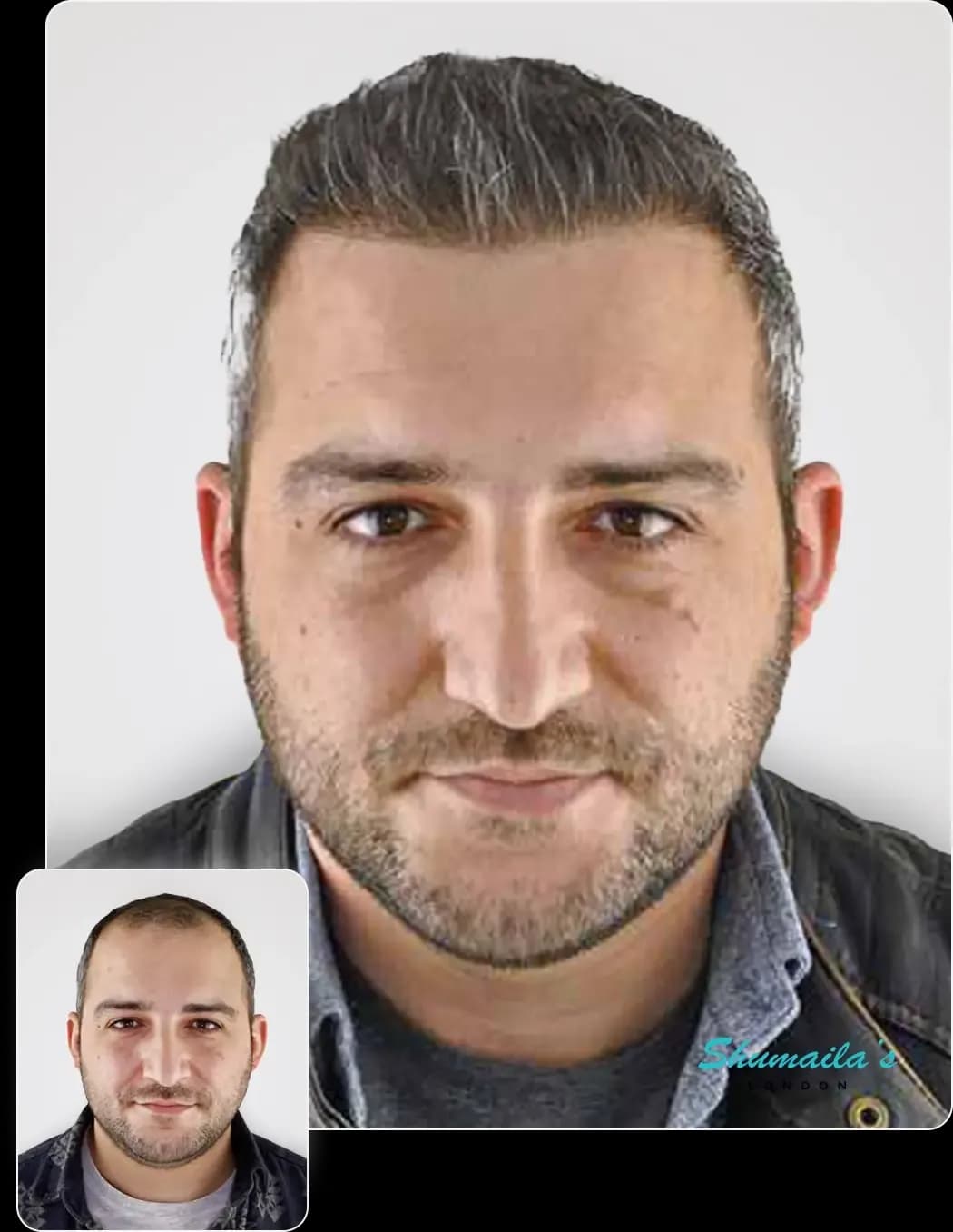 Hair Transplant