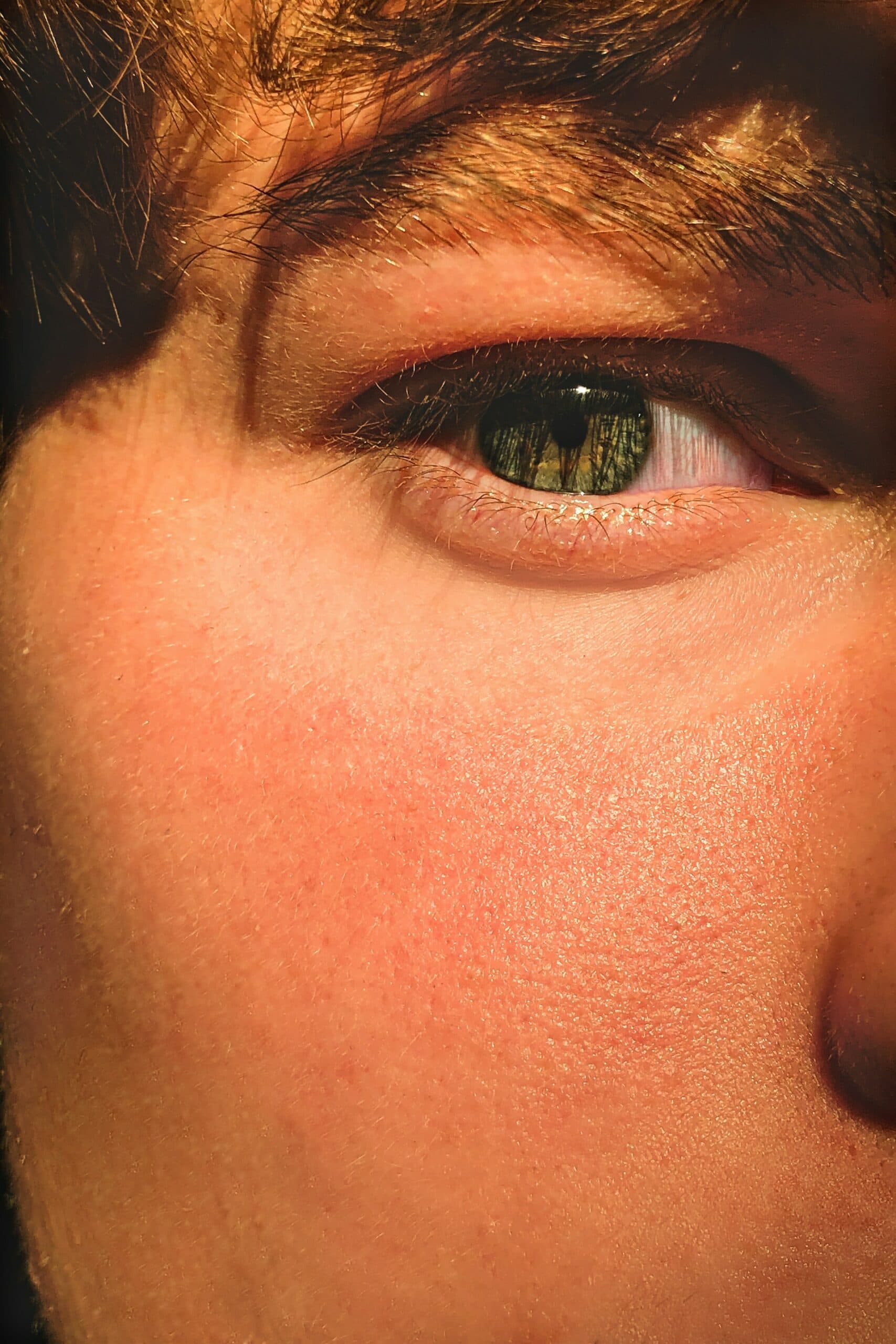 Hyperpigmentation Explained: Causes, Types, and Best Treatments in London
