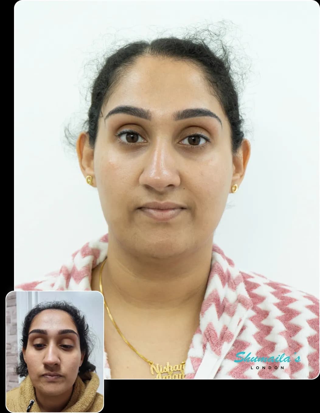 Hair Loss Treatment