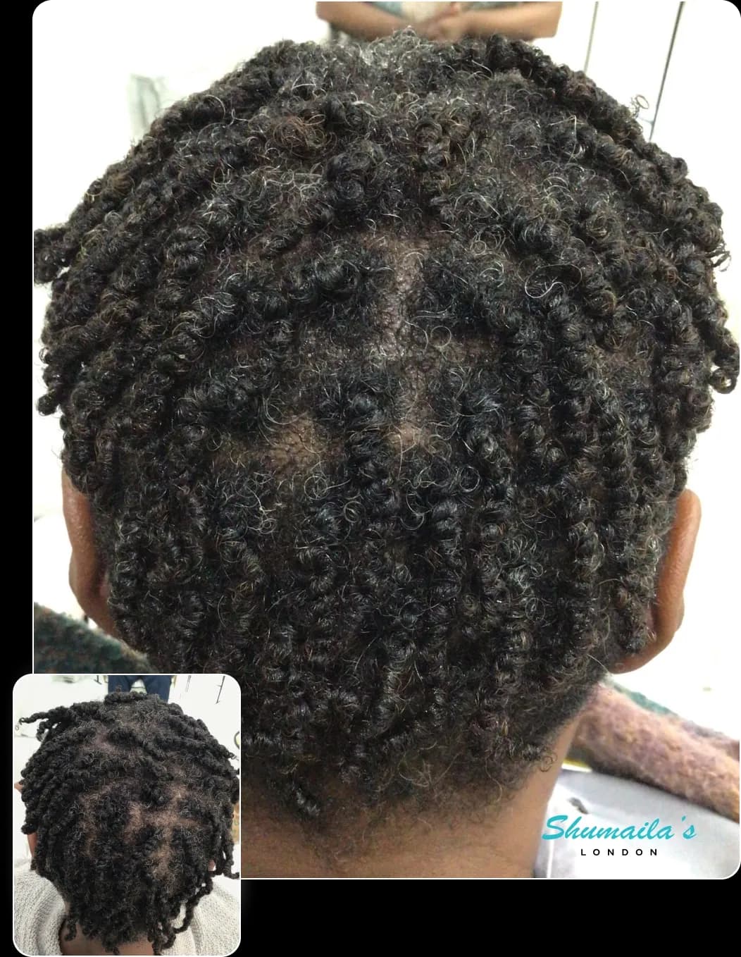 Hair Loss Treatment