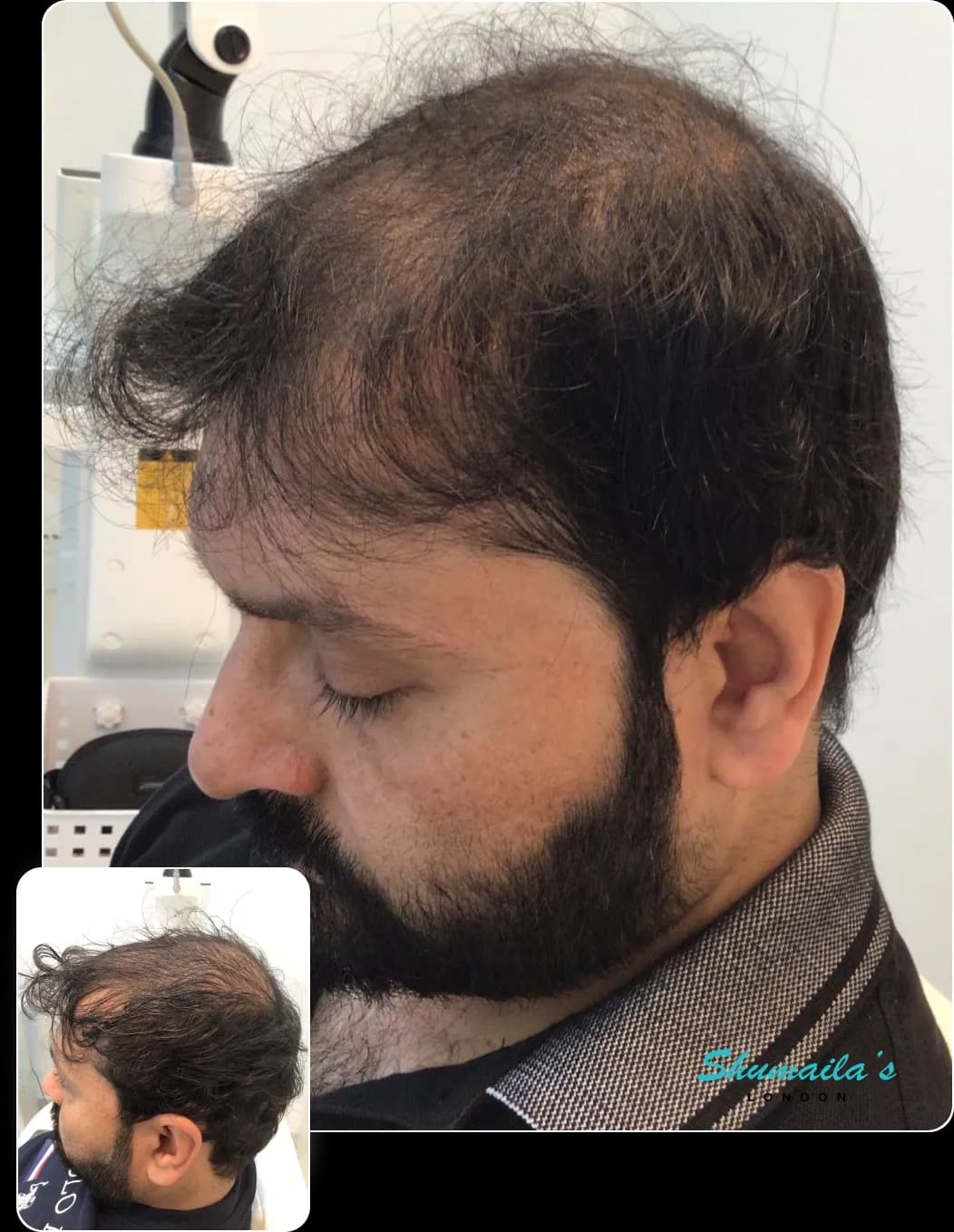 Hair Loss Treatment