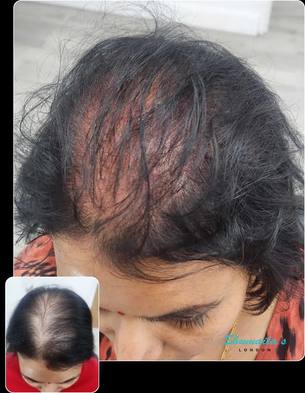 Hair Loss Treatment