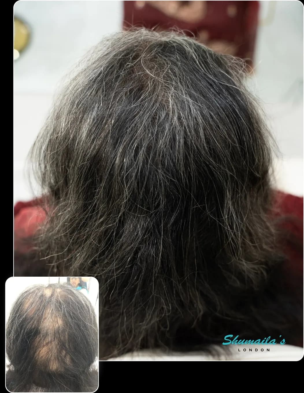 Hair Loss Treatment