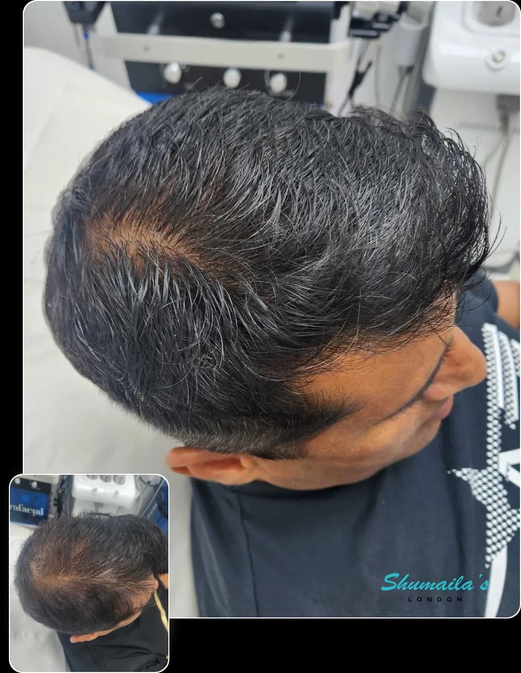 Hair Loss Treatment