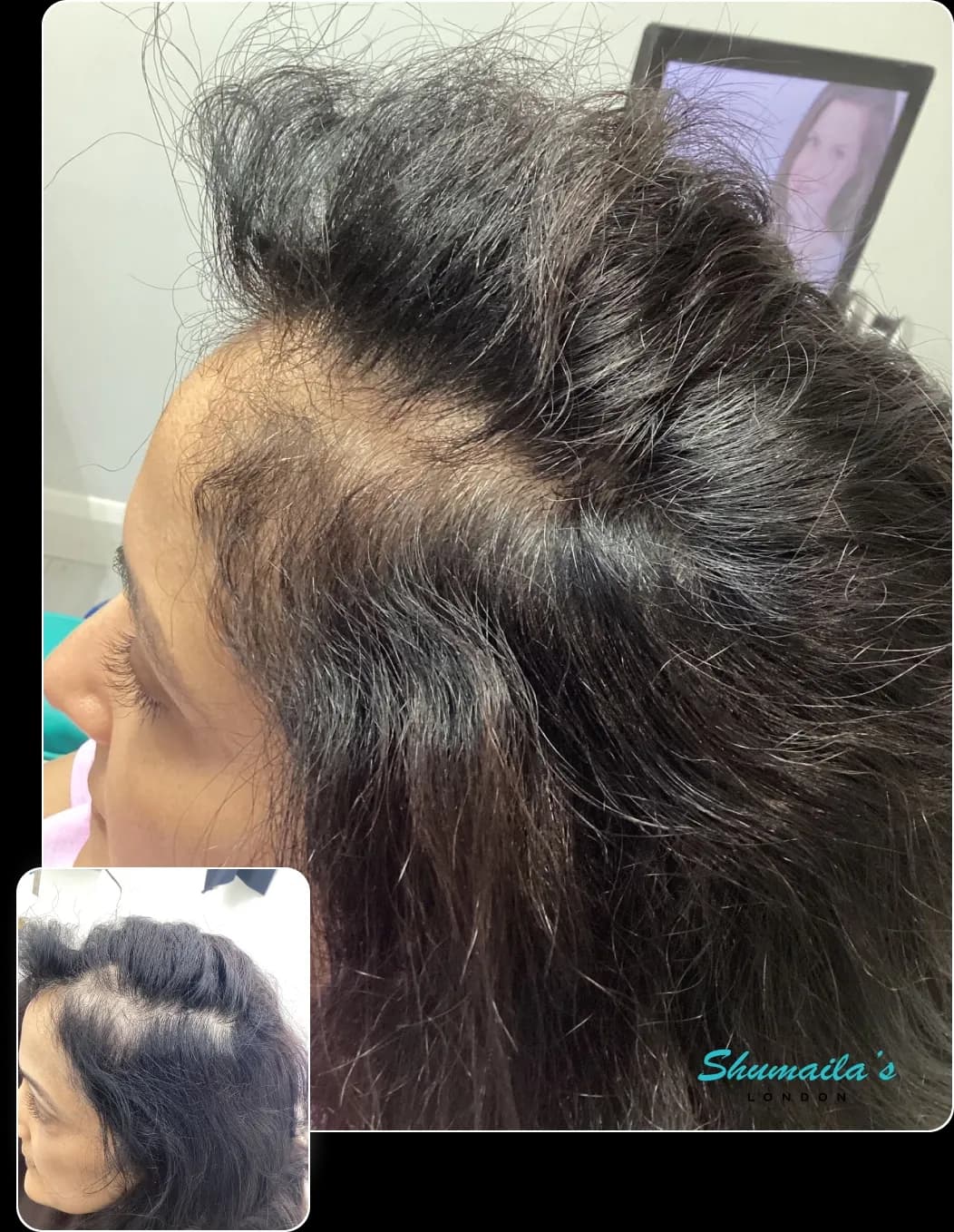 Hair Loss Treatment