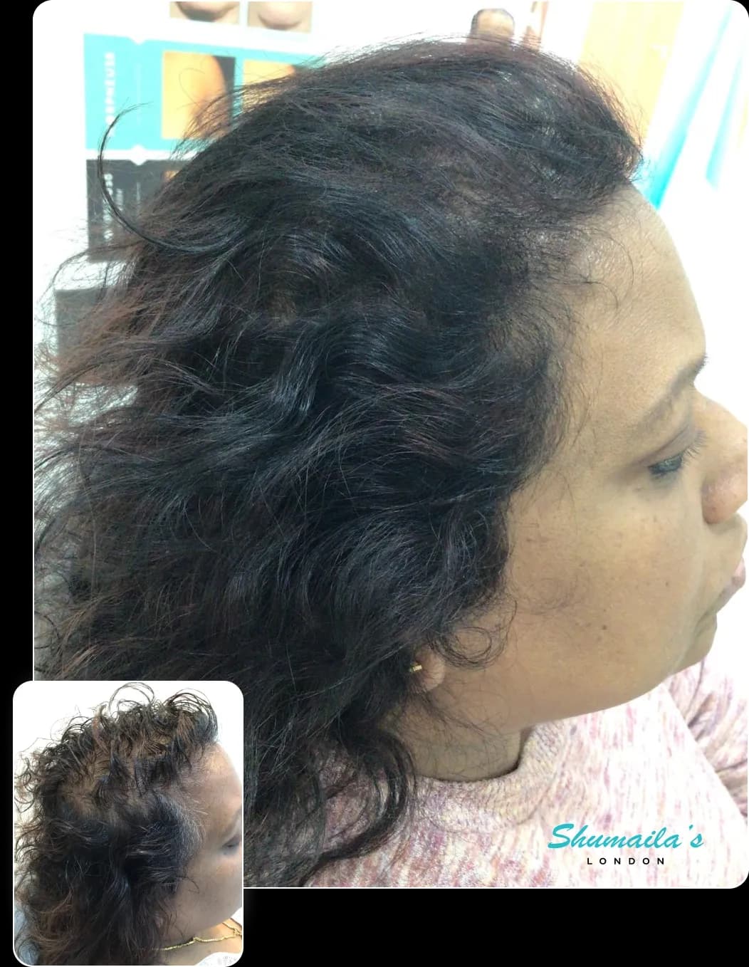 Hair Loss Treatment