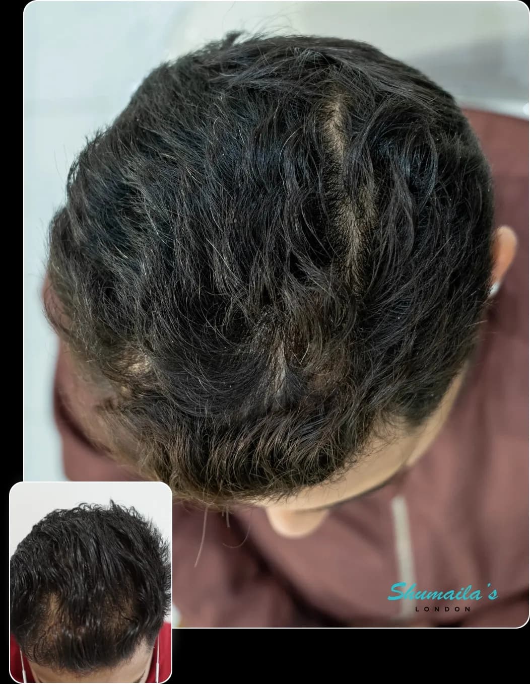 Hair Loss Treatment