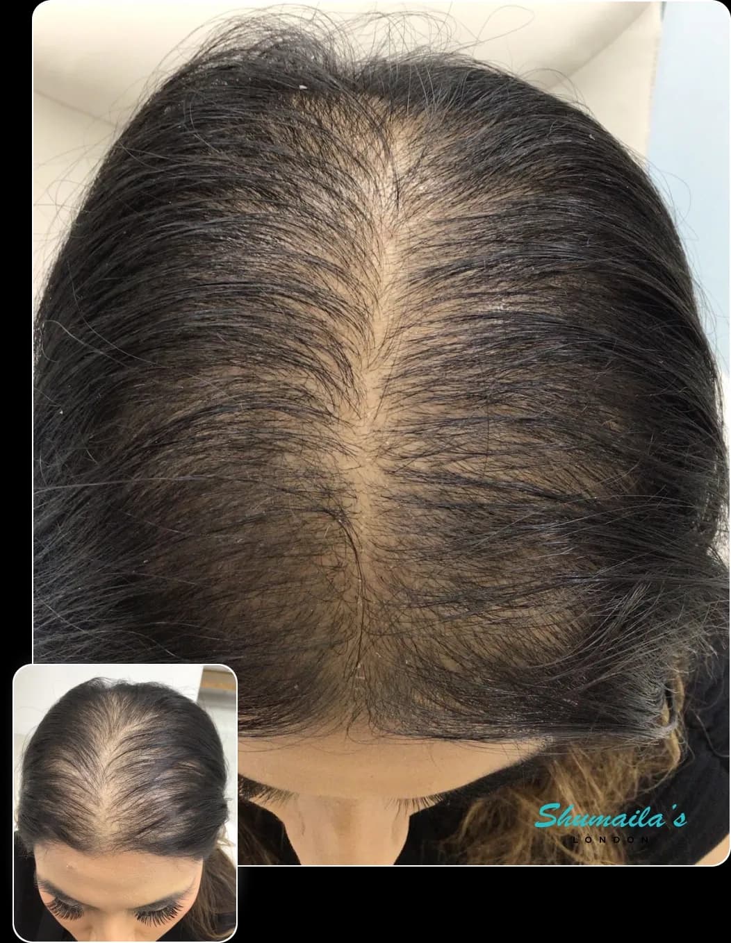 Hair Loss Treatment