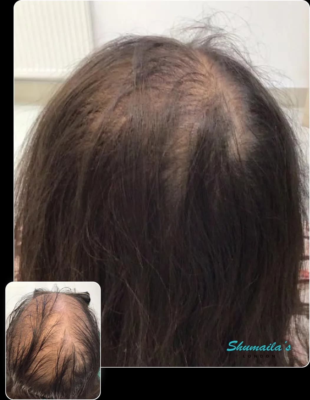 Hair Loss Treatment