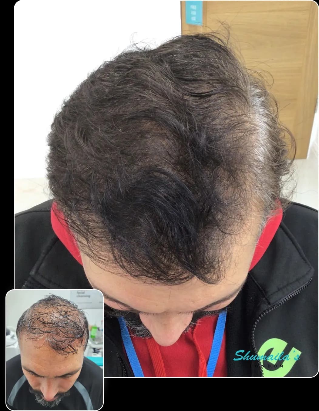 Hair Loss Treatment