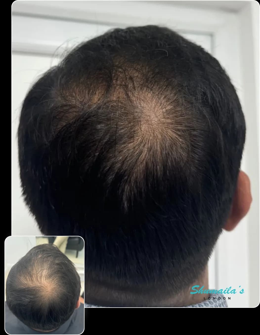 Hair Loss Treatment