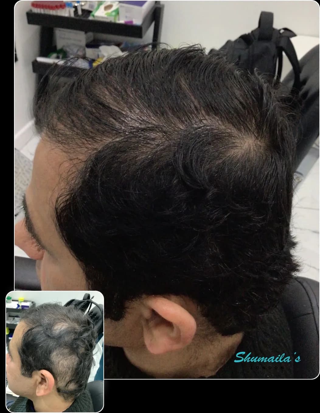 Hair Loss Treatment