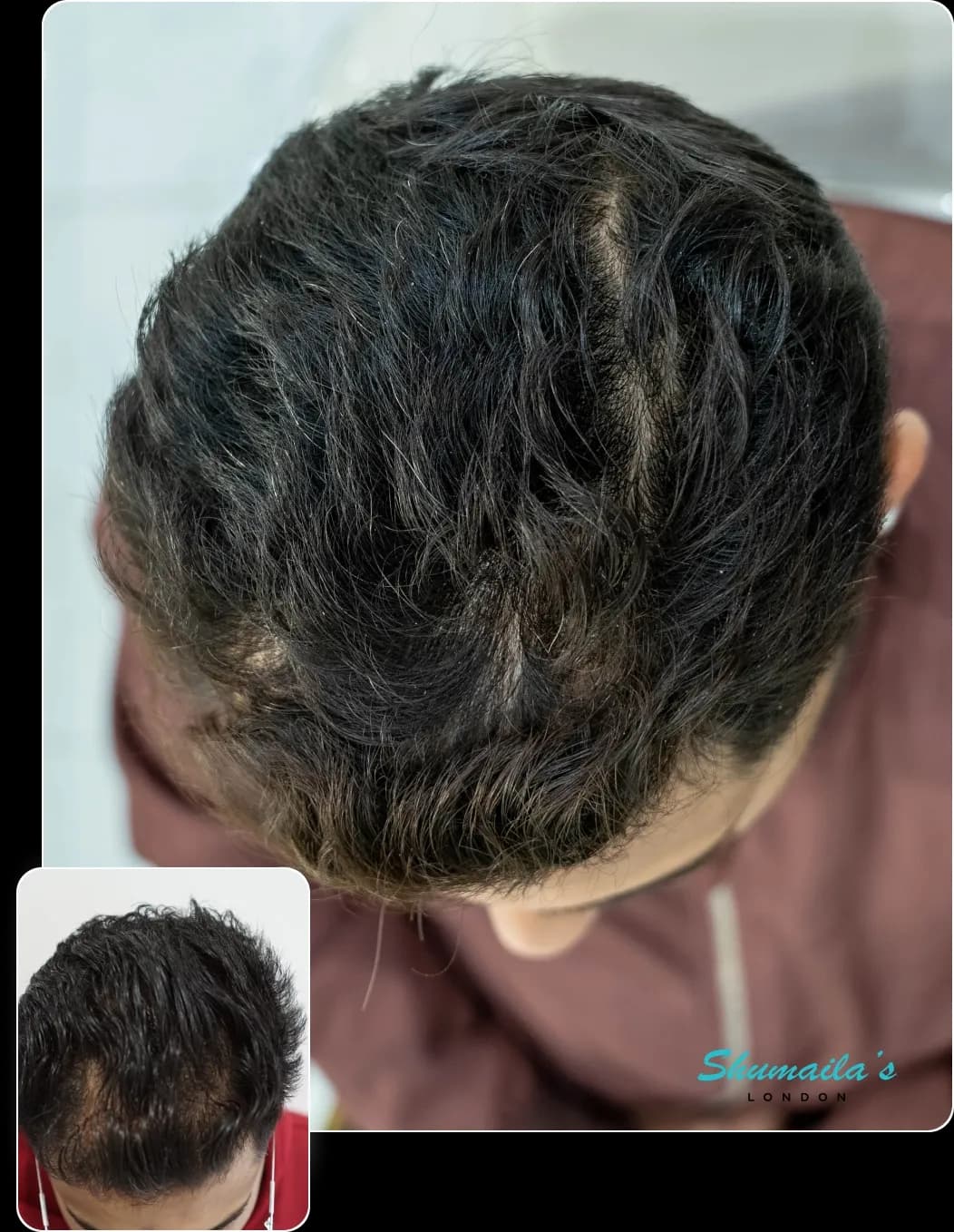 Hair Loss Treatment