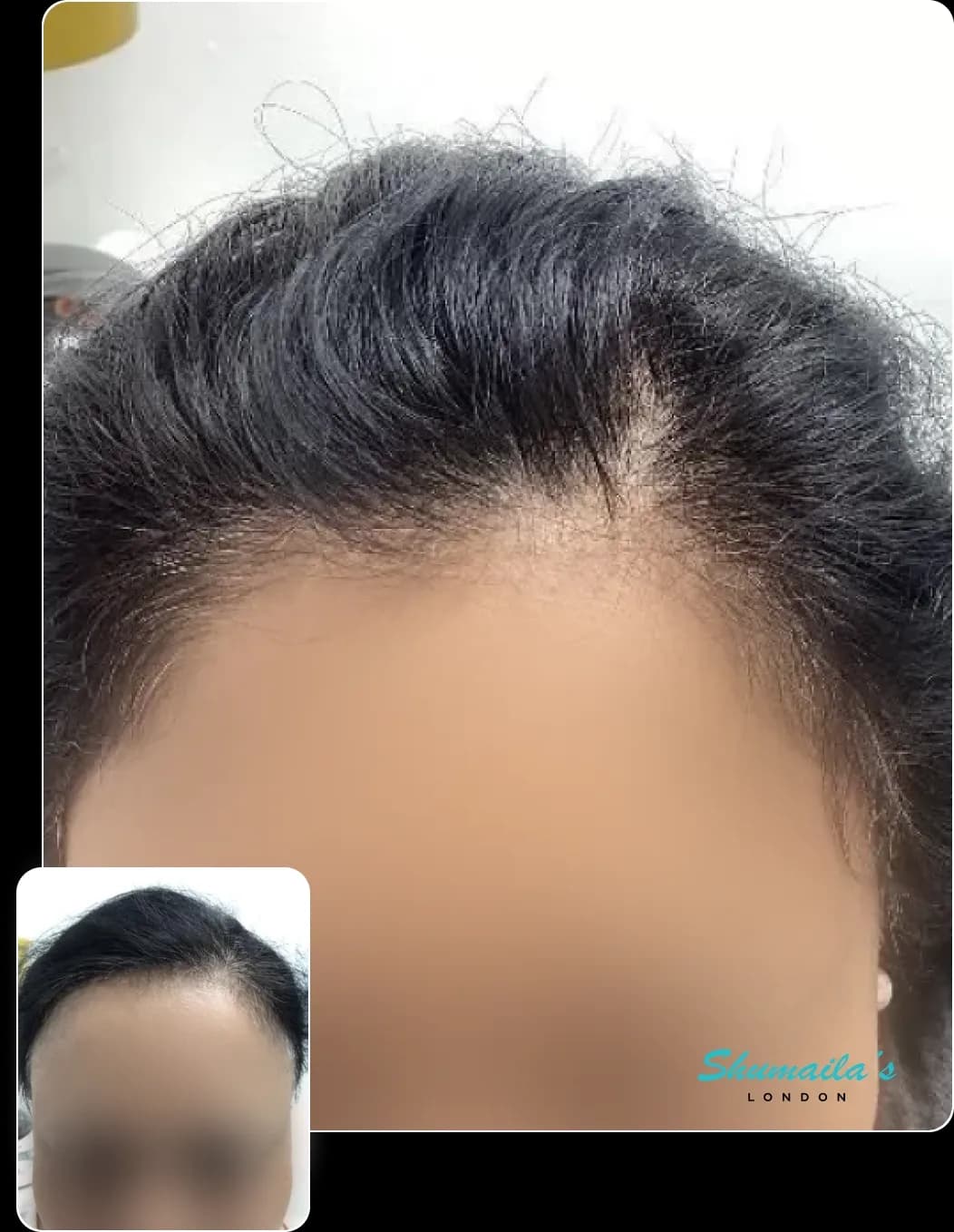 Hair Loss Treatment