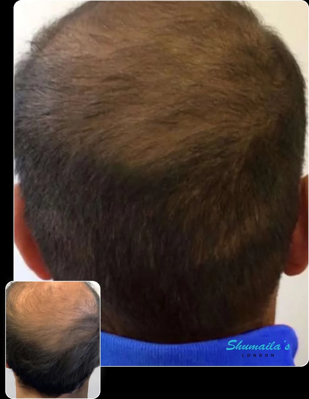 Hair Loss Treatment