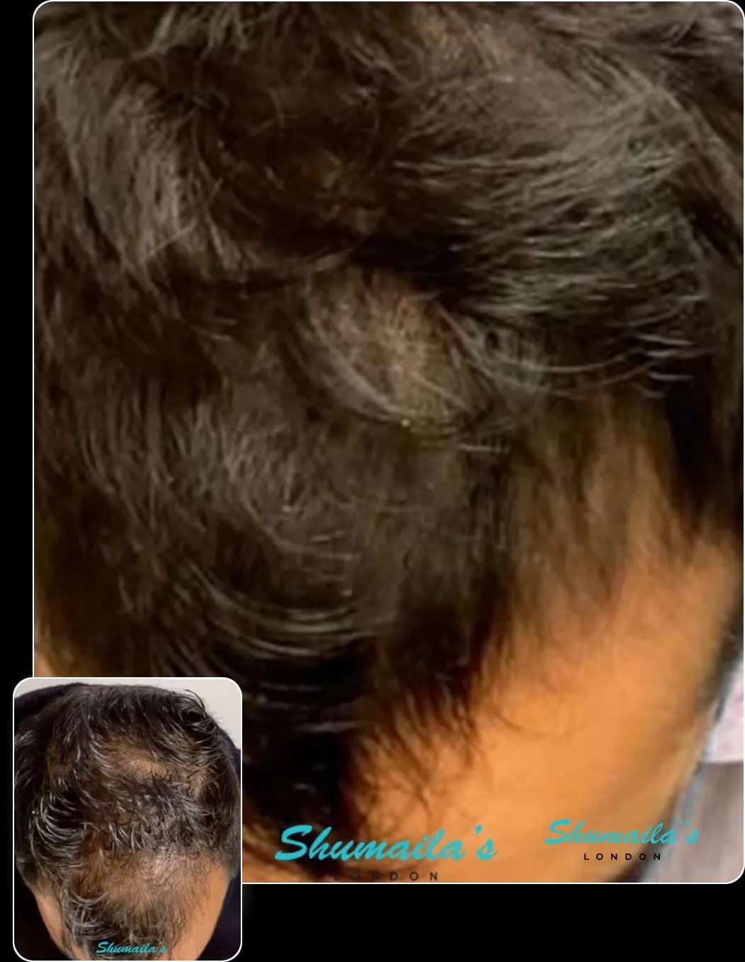 Hair Loss Treatment