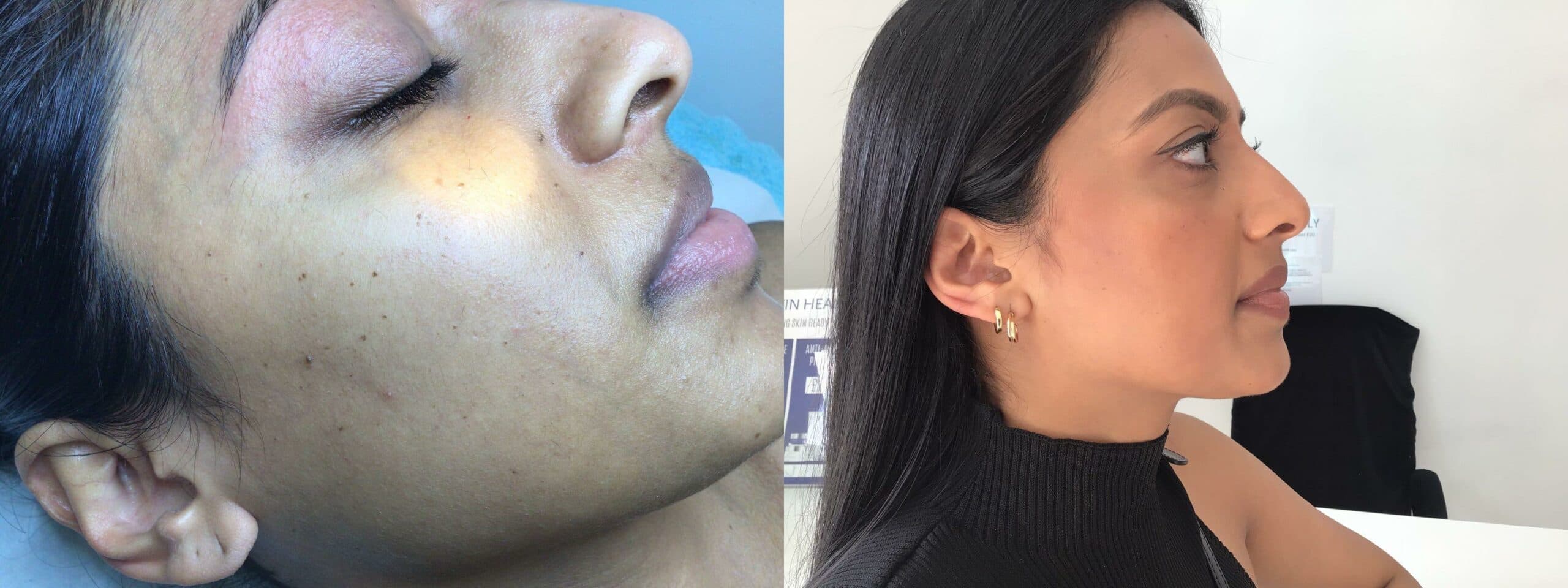 Before and after results of skin tag removal treatment showing smooth, rejuvenated skin on a woman’s face near the eye and cheek area.