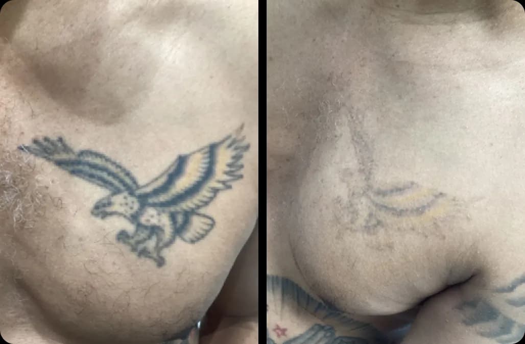 Tattoo Removal