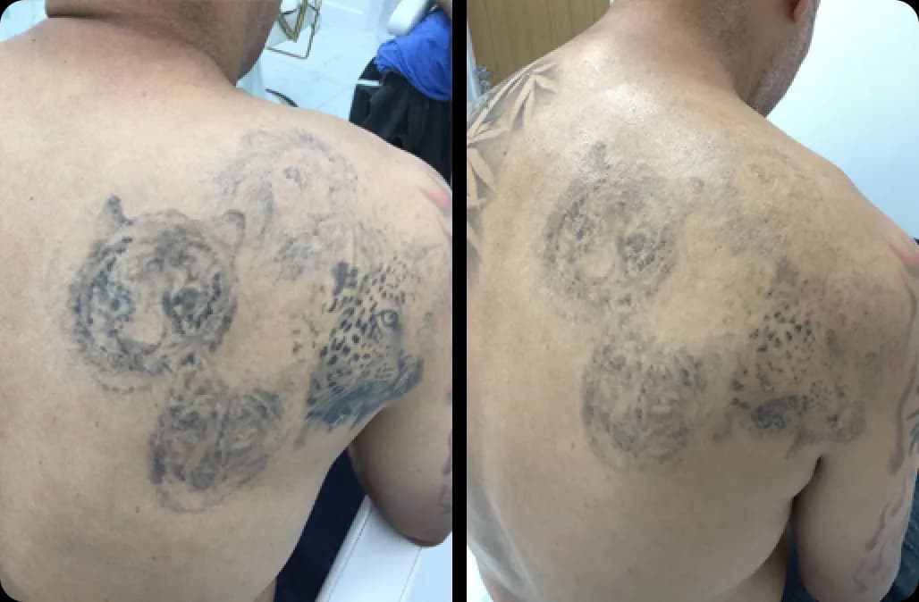 Tattoo Removal
