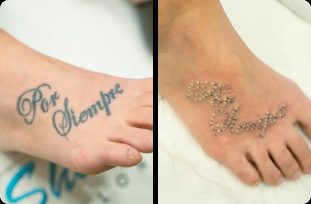 Tattoo Removal