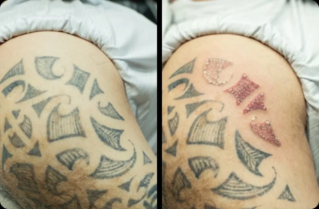 Tattoo Removal