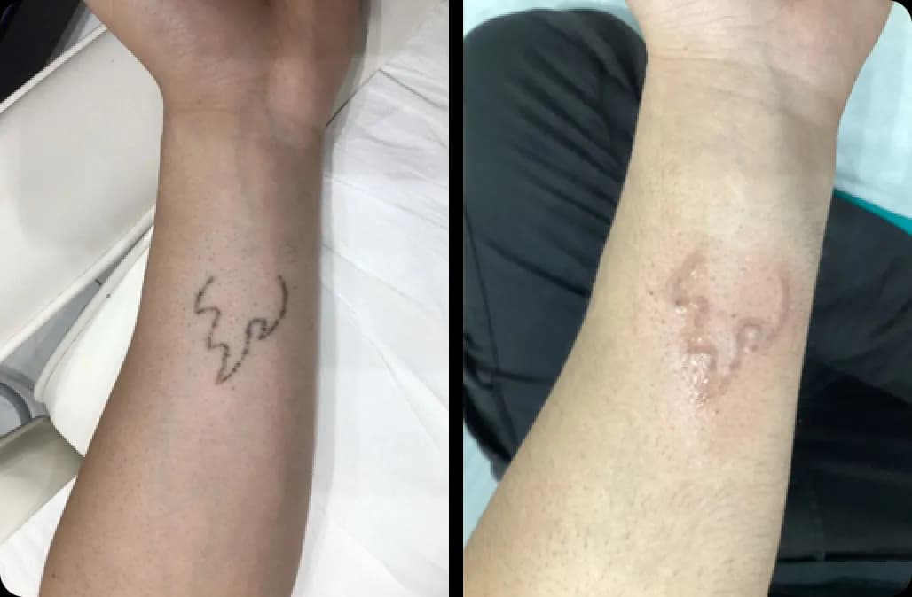 Tattoo Removal