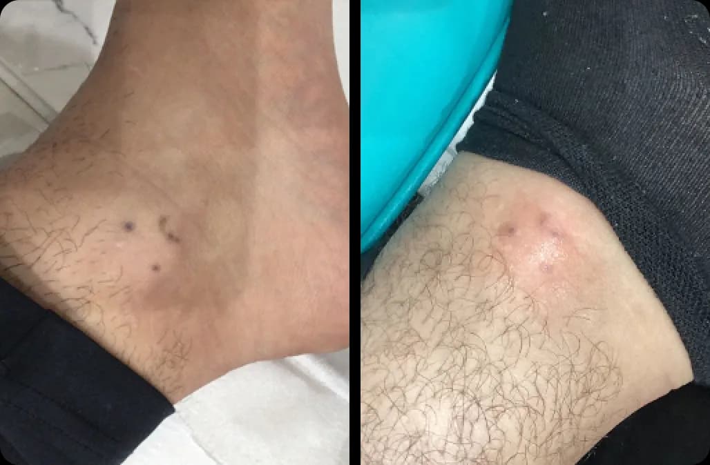 Tattoo Removal